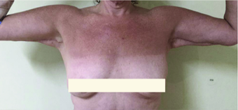 45-54 year old woman treated with Upper Body Lift (Torsoplasty and Arm Lift) before 3442490