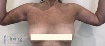 45-54 year old woman treated with Upper Body Lift (Torsoplasty and Arm Lift) after 3442490