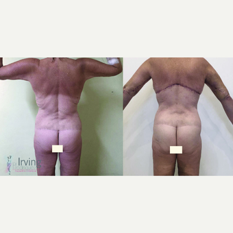 45-54 year old woman treated with Upper Body Lift (Torsoplasty and Arm Lift) 3442490