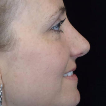 25-34 year old woman treated with Rhinoplasty after 3525961