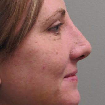 25-34 year old woman treated with Rhinoplasty before 3525961