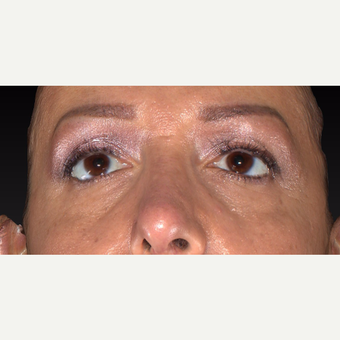 35-44 year old woman treated with Restylane before 3418976