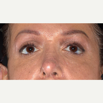 35-44 year old woman treated with Restylane after 3418976