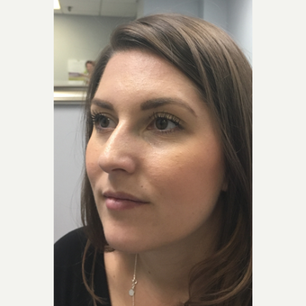 25-34 year old woman treated with Botox before 3802211