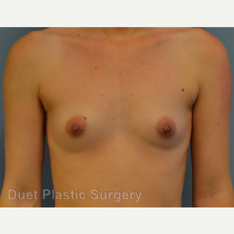 25-34 year old woman treated with Breast Augmentation before 3342187