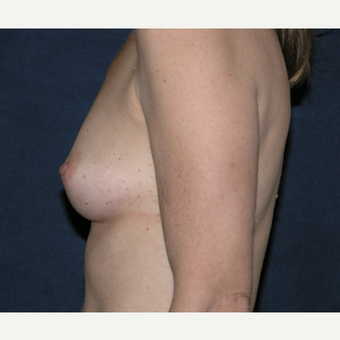 45-54 year old woman treated with Breast Implants before 3455533