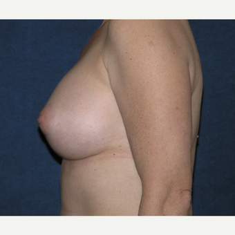45-54 year old woman treated with Breast Implants after 3455533