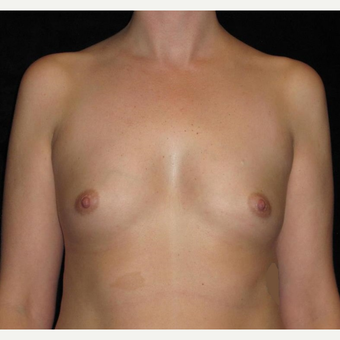 35 year old woman treated with Breast Augmentation before 3093122