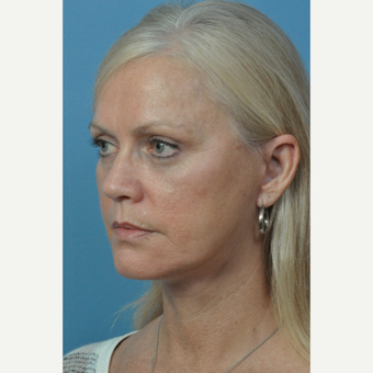 55-64 year old woman treated with Facelift after 3732408