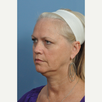 55-64 year old woman treated with Facelift before 3732408