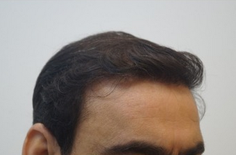 35-44 year old man treated with FUE Hair Transplant 1650309