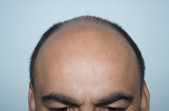 35-44 year old man treated with FUE Hair Transplant before 1650309