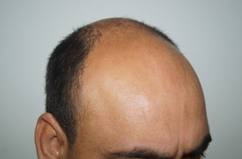 35-44 year old man treated with FUE Hair Transplant 1650309