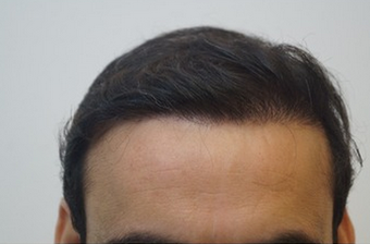 35-44 year old man treated with FUE Hair Transplant after 1650309