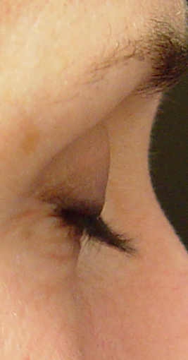Lashes treated with Lumigan/Latisse before 152211