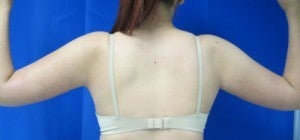 Arm Lift after 3094454