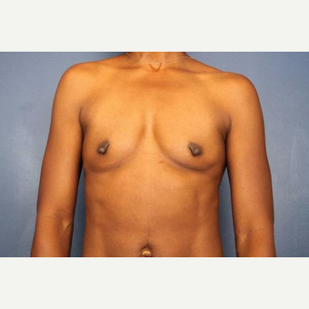 34 year old female, 400cc silicone gel high profile breast implants placed under the muscle before 3813677