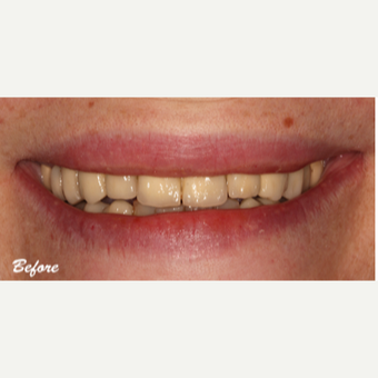 35-44 year old woman treated with Dental Crown before 3578279