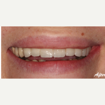 35-44 year old woman treated with Dental Crown after 3578279