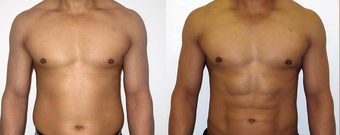 25-34 year old man treated with Vaser Liposuction before 4599300