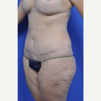 35-44 year old woman treated with Body Lift after 3450487