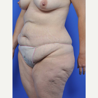 35-44 year old woman treated with Body Lift before 3450487