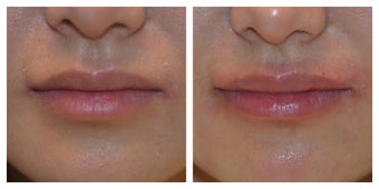 23 Year Old Female Treated for Lip Augmentation before 1373416