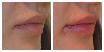 23 Year Old Female Treated for Lip Augmentation after 1373416