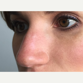 35-44 year old woman treated with Non Surgical Nose Job after 3214919