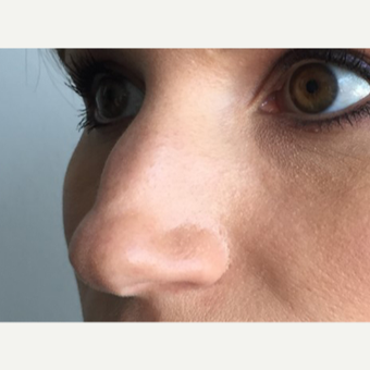 35-44 year old woman treated with Non Surgical Nose Job before 3214919