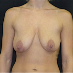 25-34 year old woman treated with Breast Lift with Implants before 3118018