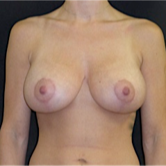 25-34 year old woman treated with Breast Lift with Implants after 3118018
