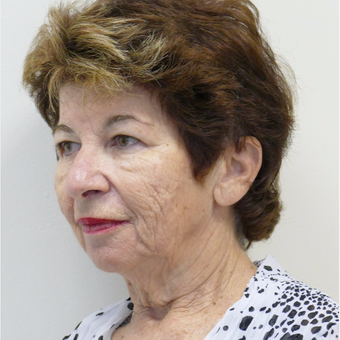 55-64 year old woman treated with Facelift and Autologous fat transfer before 3082888