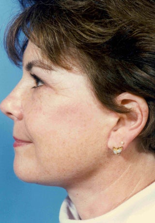 Facelift 1047992
