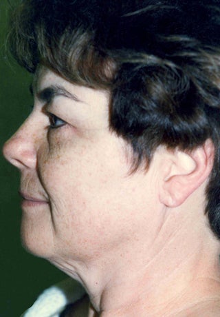 Facelift 1047992