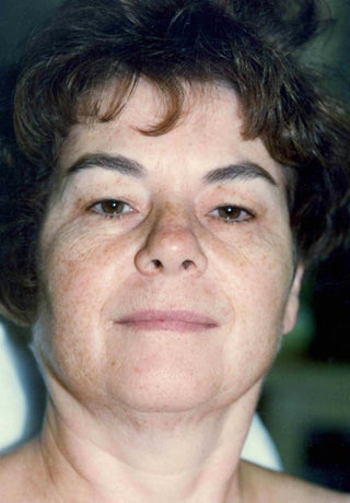 Facelift before 1047992