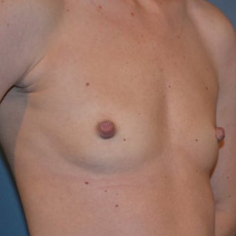 18-24 year old woman treated with Breast Augmentation 1570036