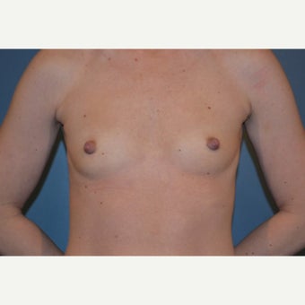 18-24 year old woman treated with Breast Augmentation before 1570036