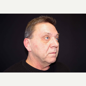 55-64 year old man treated with Fat Transfer and Direct Neck Lift before 3439295