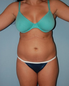 Smart Lipo before 1409631
