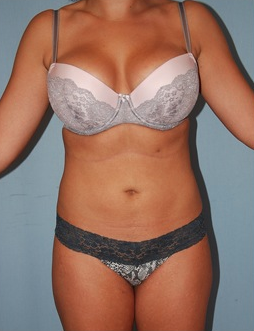 Smart Lipo after 1409631