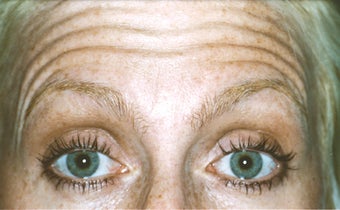 BOTOX before 1002871
