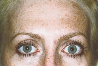 BOTOX after 1002871
