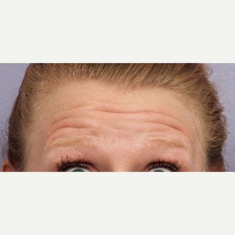 25-34 year old woman treated with Botox before 3660275