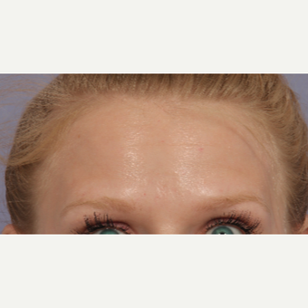 25-34 year old woman treated with Botox after 3660275