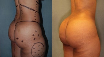 28 year old woman treated with Fat Transfer to Buttock. Gained 4 Inches before 1811311