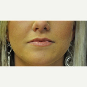 25-34 year old woman treated with Juvederm before 2881437