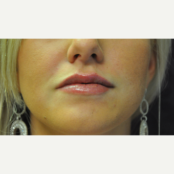25-34 year old woman treated with Juvederm after 2881437