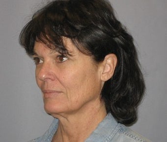 54 Year Old Seeks More Youthful Appearance 1475033