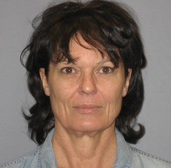 54 Year Old Seeks More Youthful Appearance before 1475033